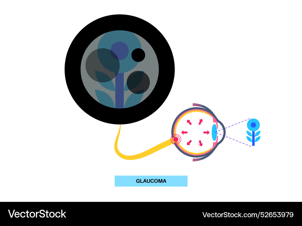 Glaucoma eye disease Royalty Free Vector Image
