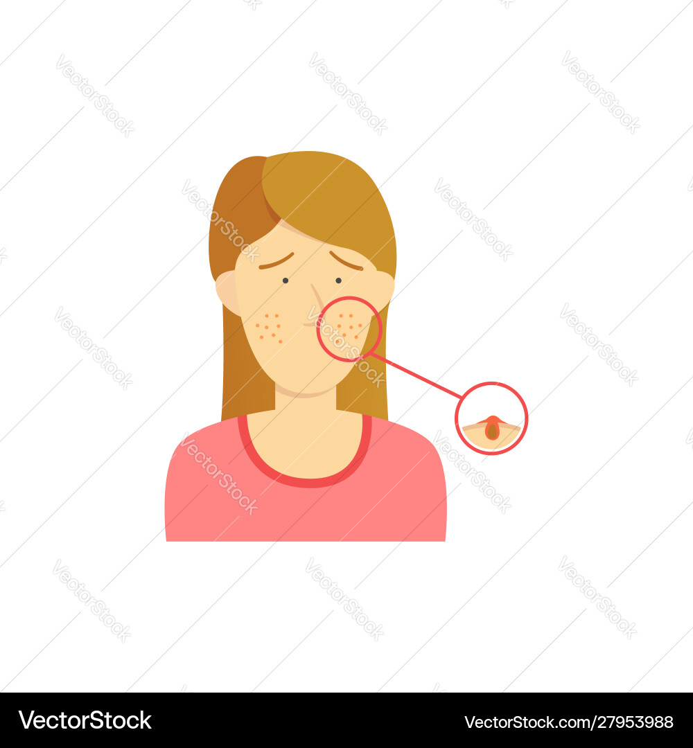 Brown hair girl woman with acne diagram detail vector image