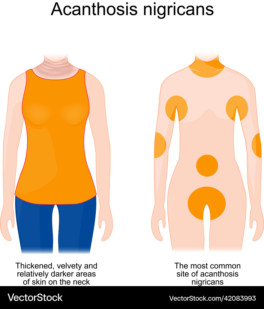 Acanthosis nigricans sign and symptoms Acanthosis nigricans sign and symptoms vector image