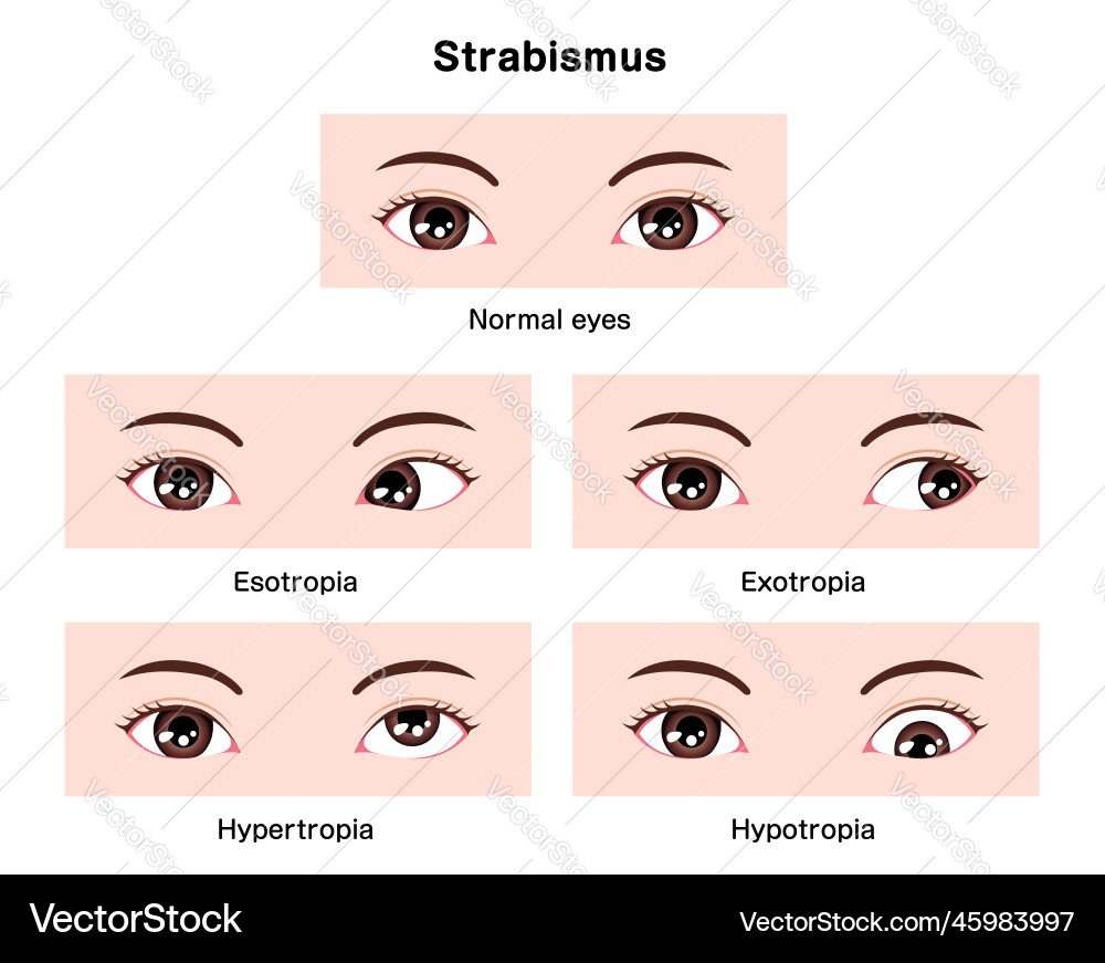 Types of Strabismus - Medical Diagram – Royalty-Free Vector | VectorStock, image size:1000x871