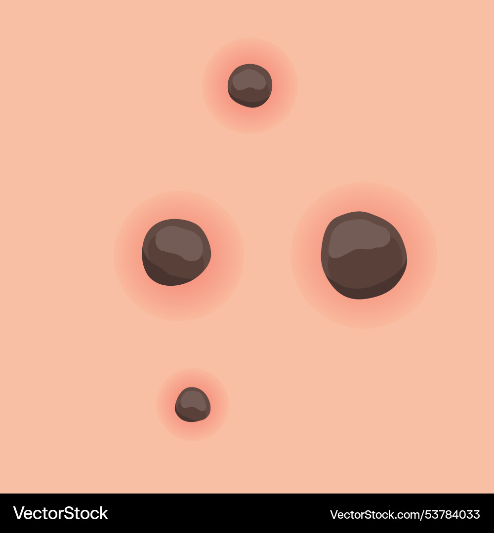 Understanding type of acne a comprehensive visual Understanding type of acne a comprehensive visual Vector Image