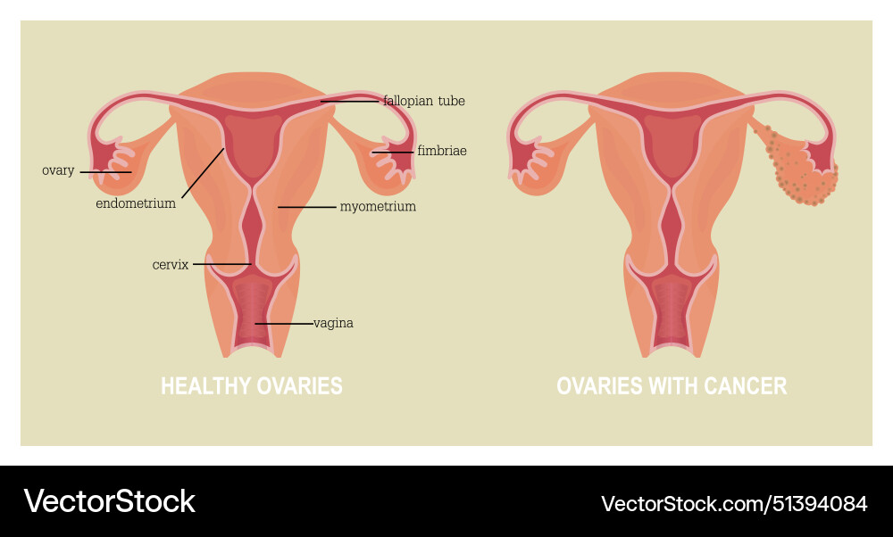Ovarian Krebs bezieht sich auf jedes Krebswachstum Ovarian Krebs bezieht sich auf jedes Krebswachstum vektorbild