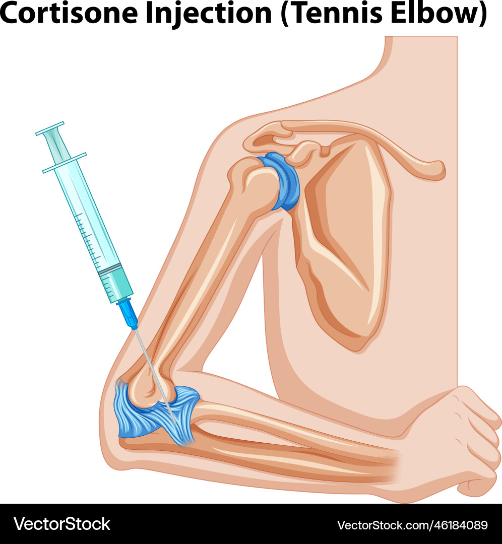 Cortisone injection tennis elbow diagram Cortisone injection tennis elbow diagram vector image