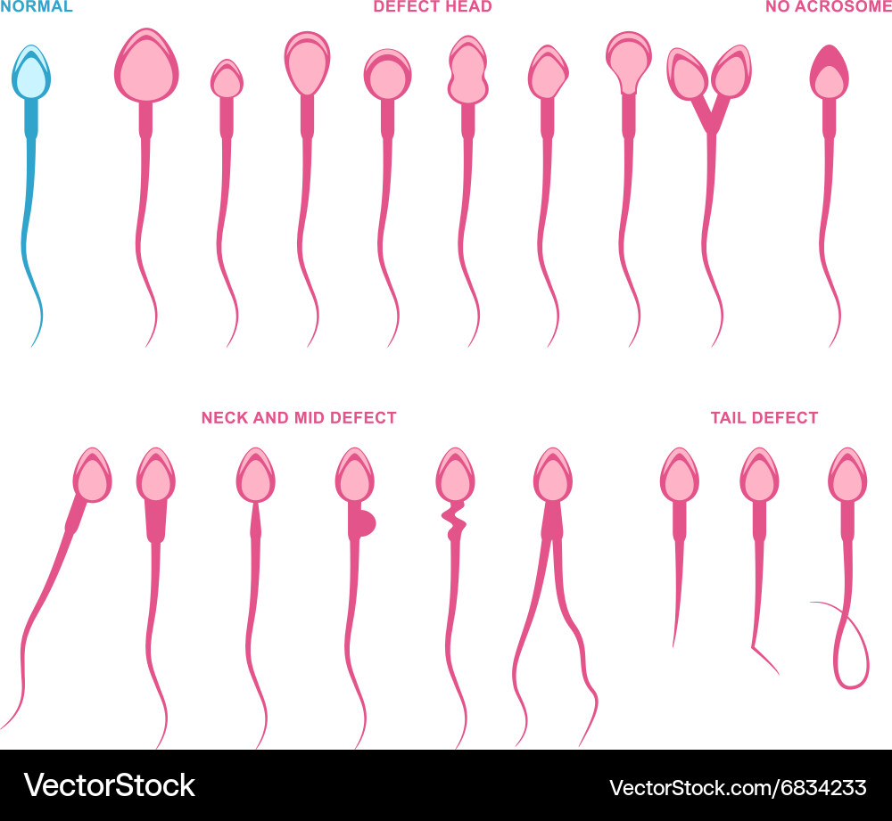 Sperm Analysis: Abnormalities and Normal Parameter Vector Image