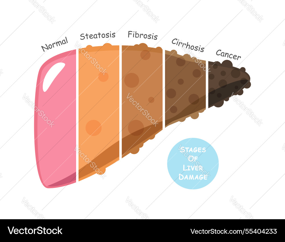 Stages of liver damage include steatosis or fatty Stages of liver damage include steatosis or fatty vector image
