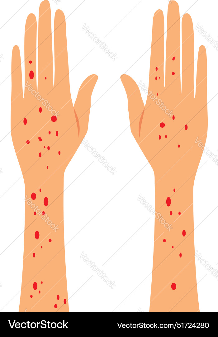 Hands with rash symptoms cartoon Royalty Free Vector Image