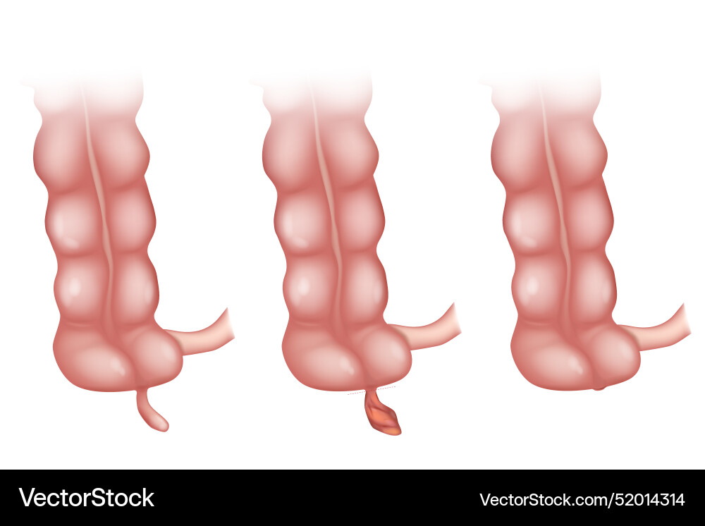 Appendicitis is an inflammation of the appendix Appendicitis is an inflammation of the appendix vector image
