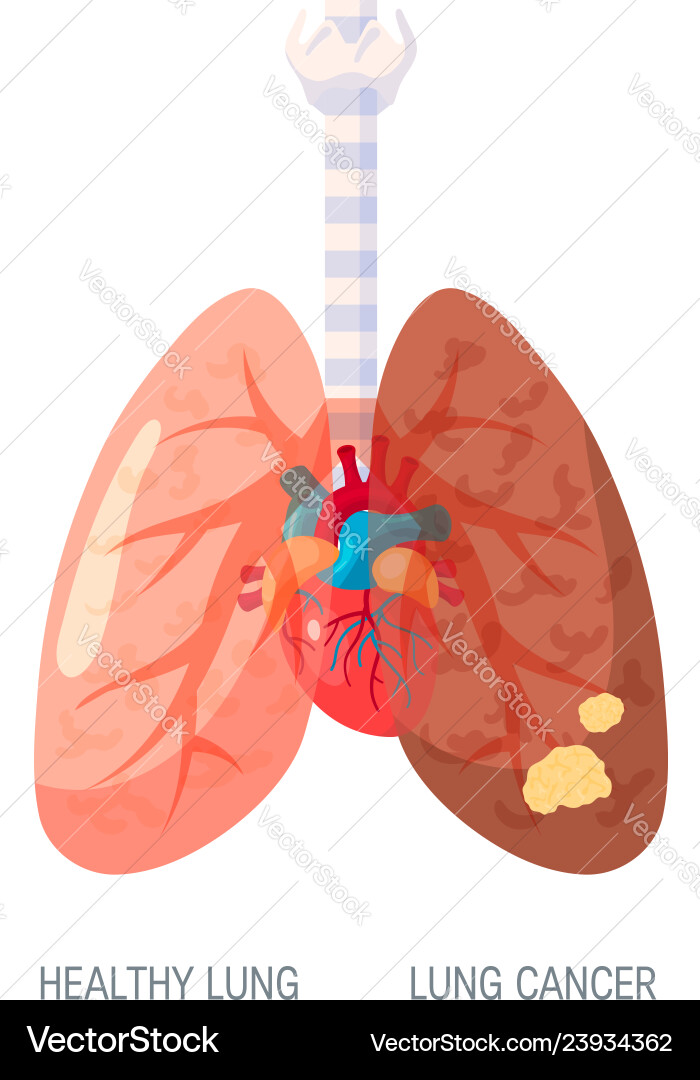 Lung Krebs Konzept im flachen Stil Lung Krebs Konzept im flachen Stil vektorbild