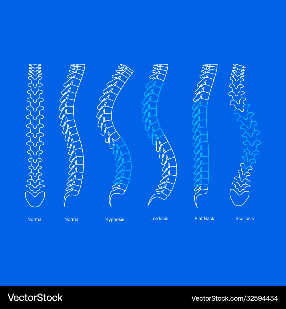 Osteoporosis bone types infographics concept card Osteoporosis bone types infographics concept card vector image