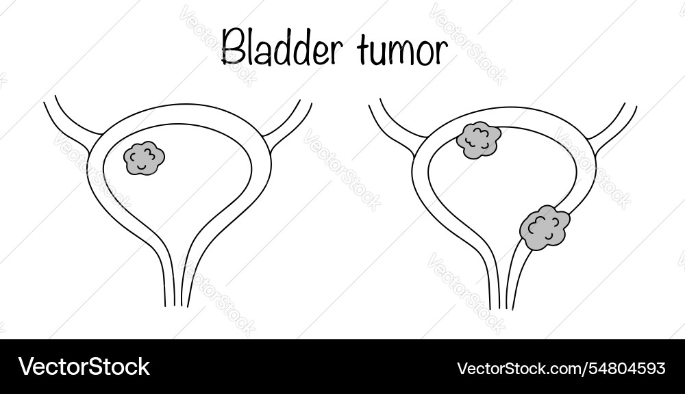 Bladder tumor Bladder tumor vector image