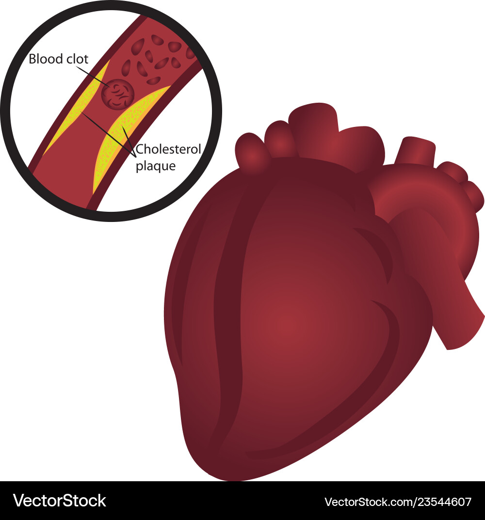 Blutgerinnsel Cholesterin Plaque i Herzinfarkt Blutgerinnsel Cholesterin Plaque i Herzinfarkt vektorbild