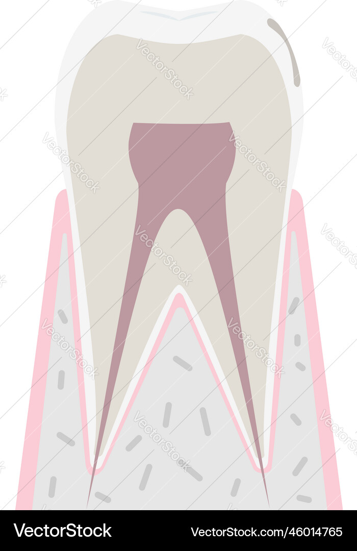 Initial stage of caries cloudy surface Vector Image