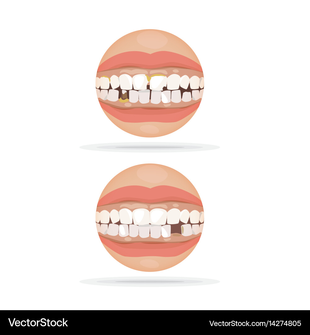 Decayed Tooth Close-Up Vector Image