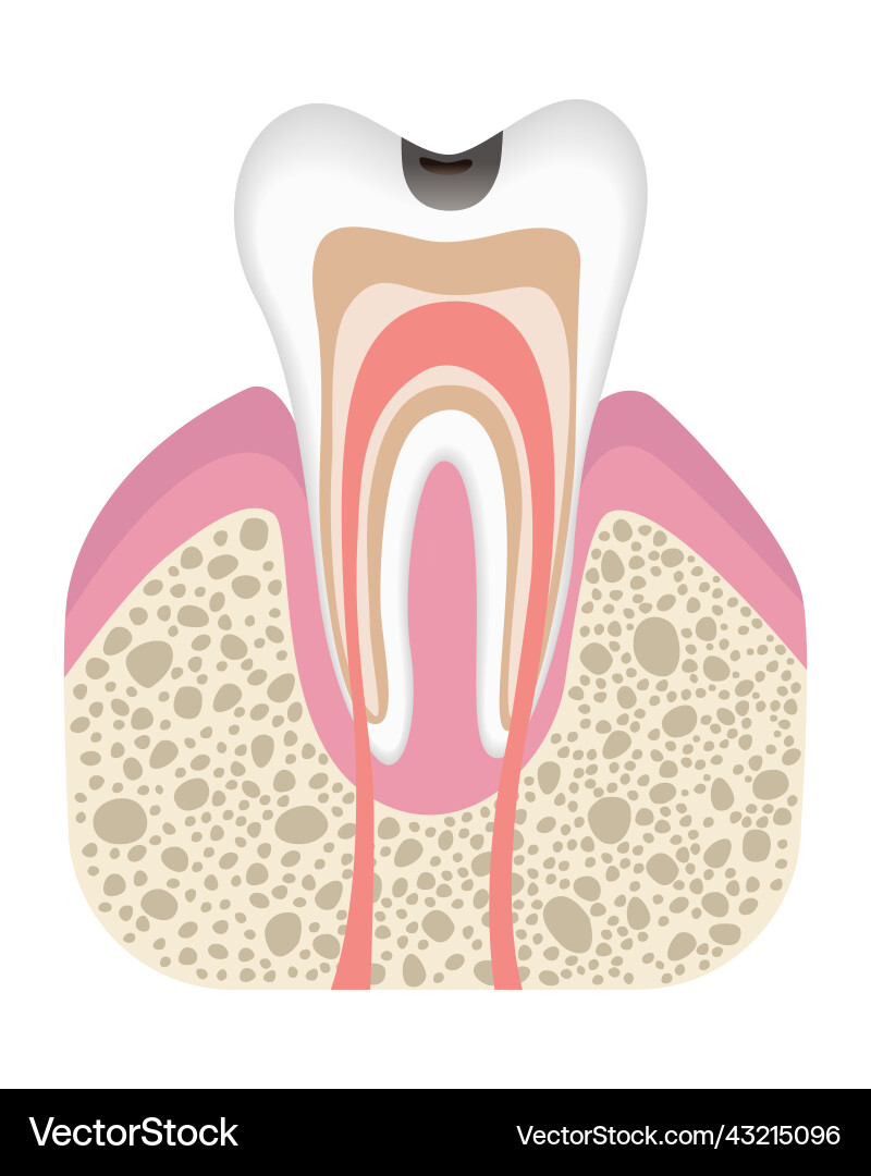 Stage of caries development tooth structure Stage of caries development tooth structure vector image
