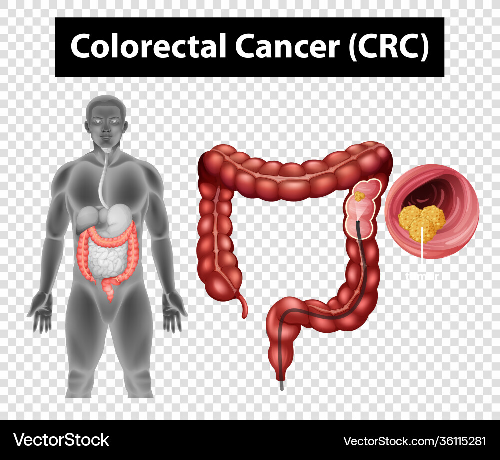 Diagram showing colorectal cancer crc Diagram showing colorectal cancer crc vector image