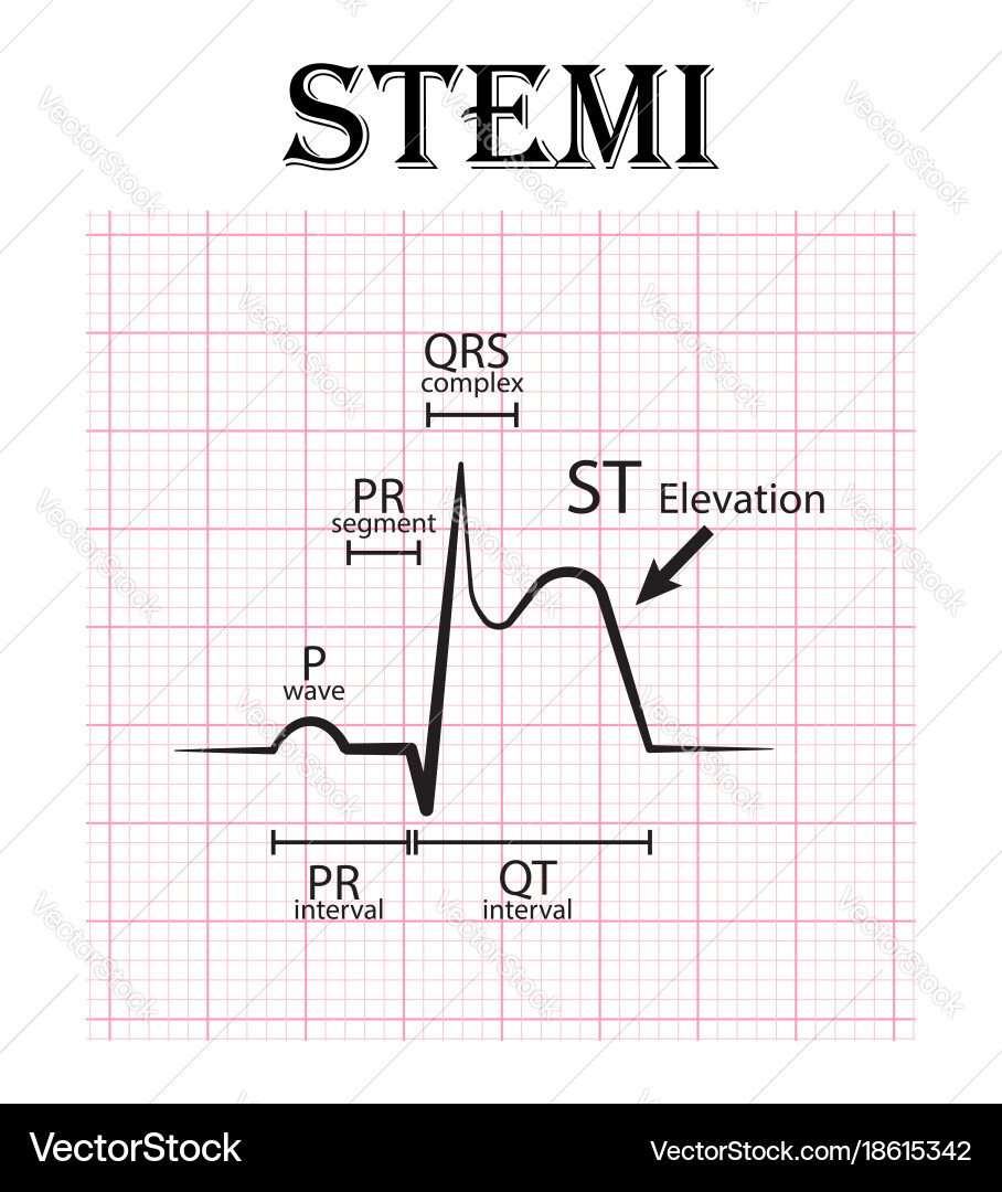 Ecg of st elevation myocardial infarction stemi vector image