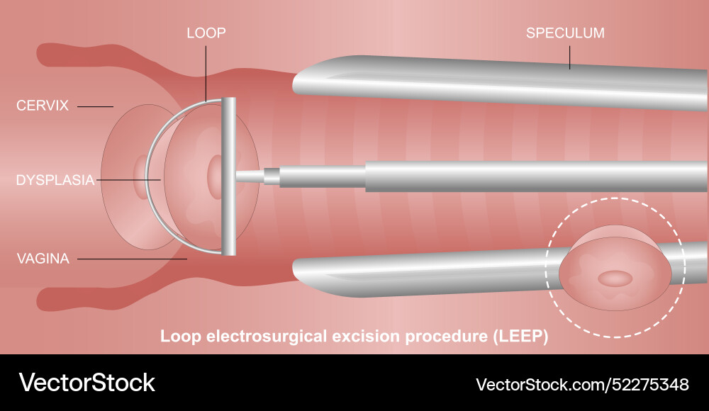 A leep loop electrosurgical excision procedure A leep loop electrosurgical excision procedure vector image