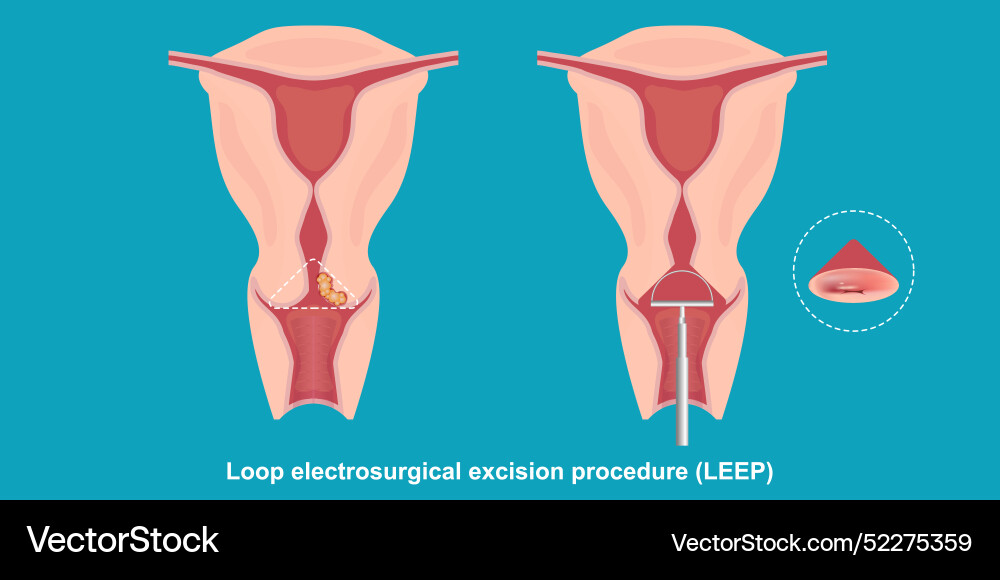 Loop electrosurgical excision procedure leep uses Loop electrosurgical excision procedure leep uses vector image