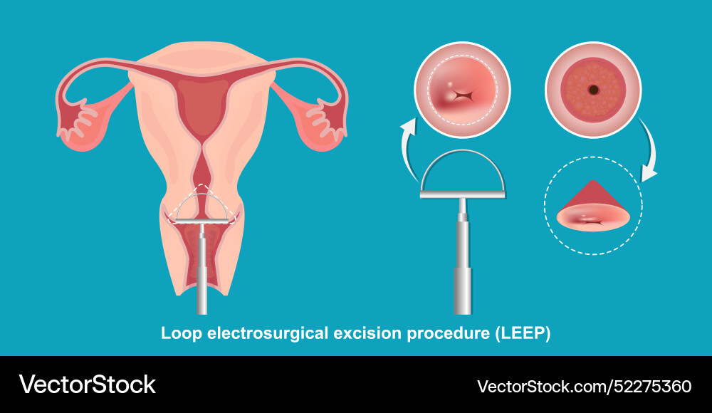 Loop electrosurgical excision procedure leep vector image