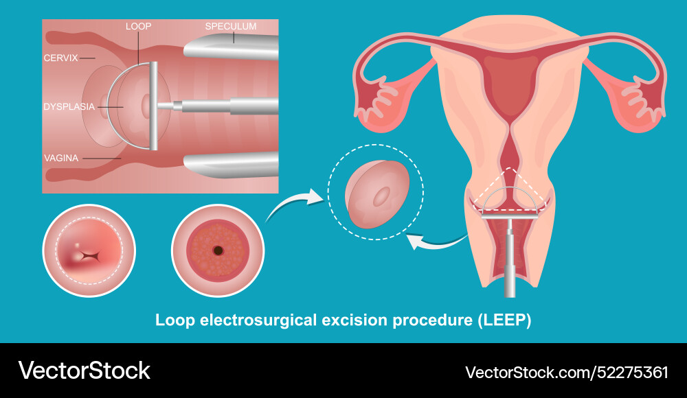Loop Electrosurgical Excision Procedure (LEEP) – Royalty-Free Vector ...