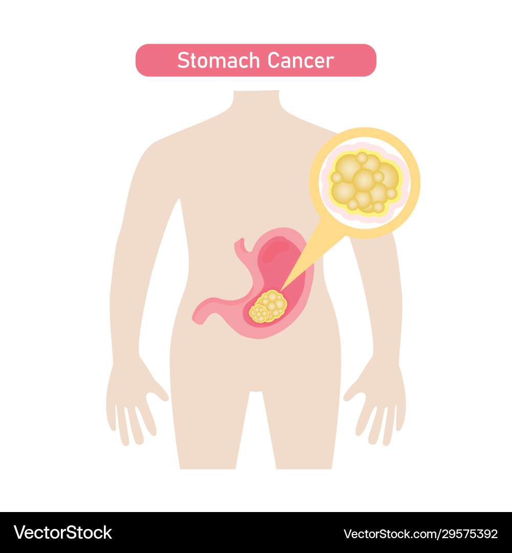 Stomach Krebs Diagramm in fla Stomach Krebs Diagramm in fla vektorbild