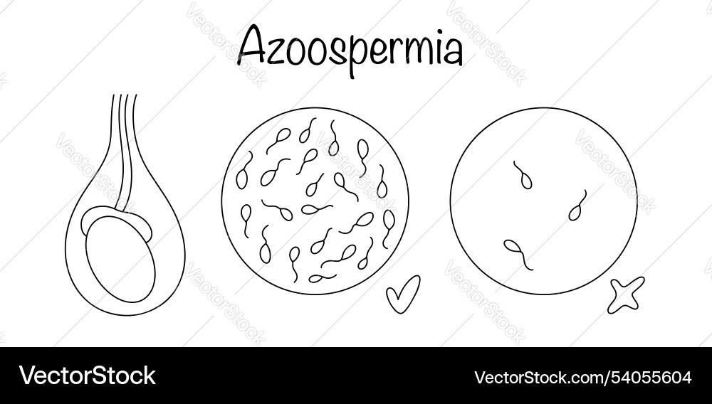 Azoospermia Azoospermia vector image