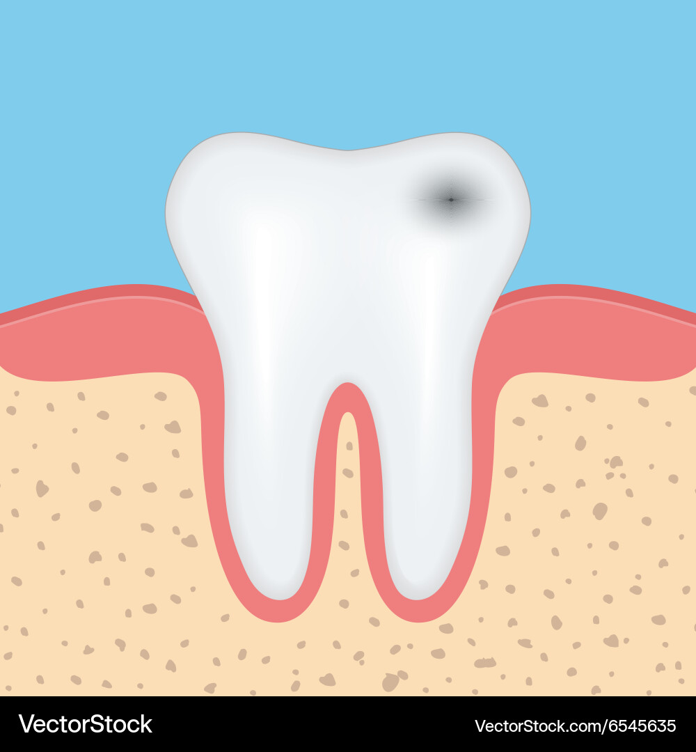 Human tooth with caries Royalty Free Vector Image