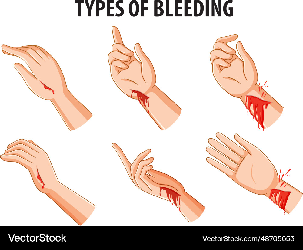 Comparing different types of bleeding on human Vector Image