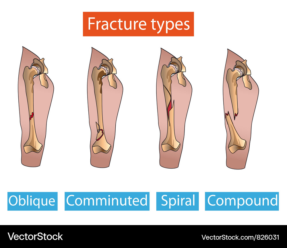 Types of fractures Vector Image