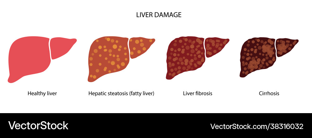 Liver disease concept vector image