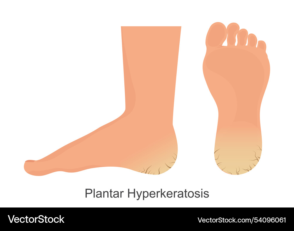 Plantar hyperkeratosis is keratin overgrowth Plantar hyperkeratosis is keratin overgrowth vector image