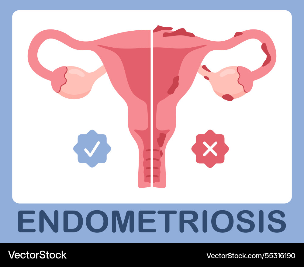 Uterus with endometriosis infographic in flat Uterus with endometriosis infographic in flat vector image