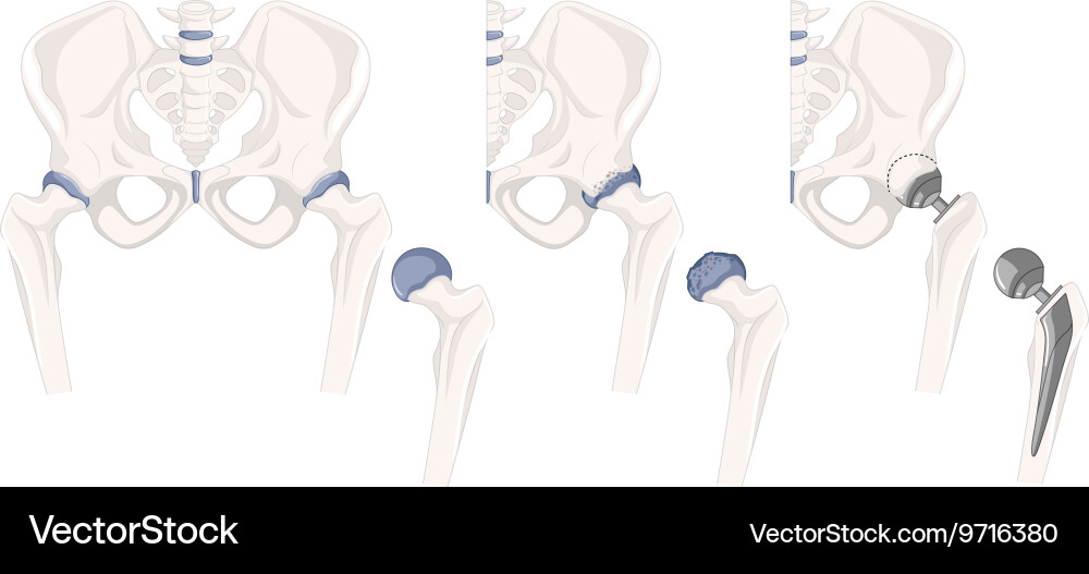 Problem with hip bones vector image