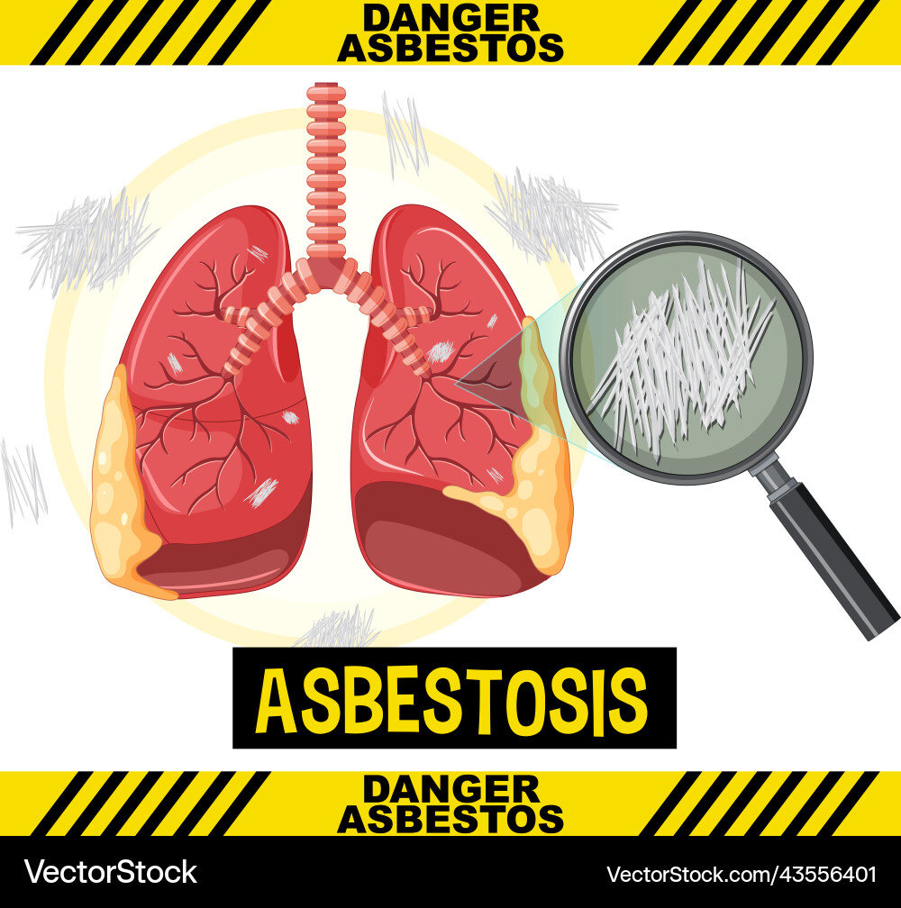 Diagram showing asbestosis in lungs Vector Image
