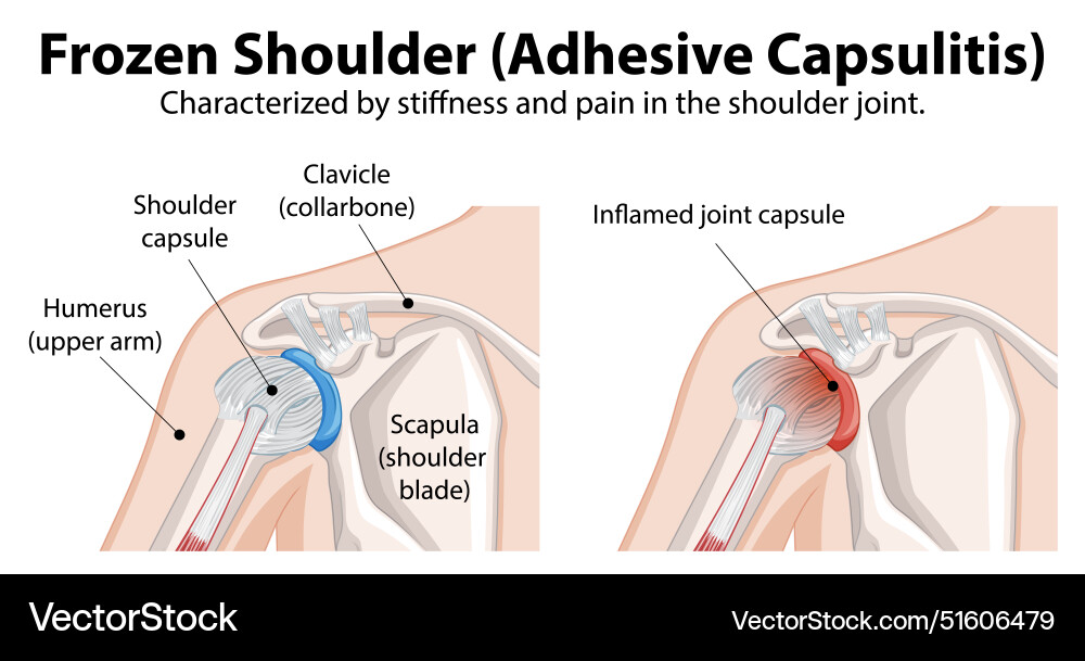 Diagram explaining adhesive capsulitis Royalty Free Vector