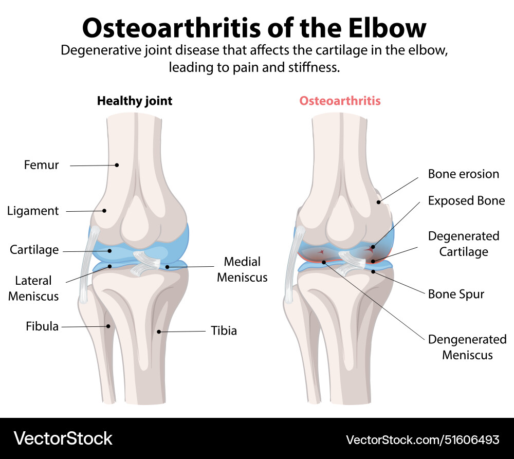 Comparison of healthy and osteoarthritic elbow Comparison of healthy and osteoarthritic elbow vector image
