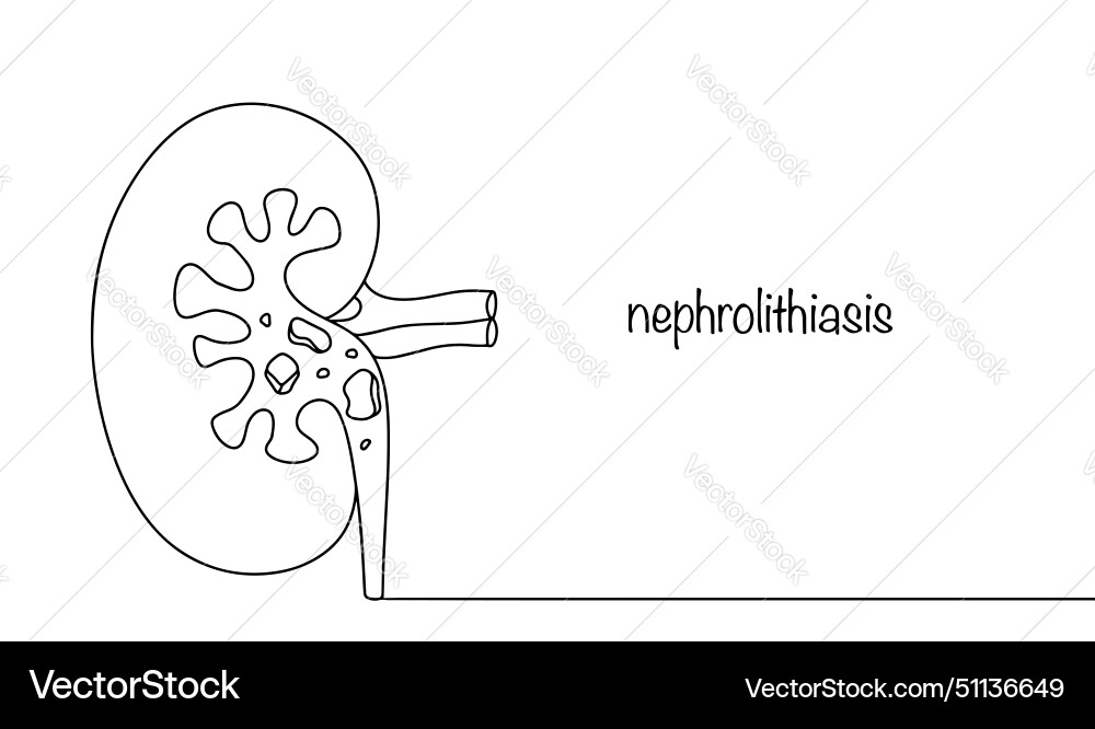 Urolithiasis Urolithiasis vector image