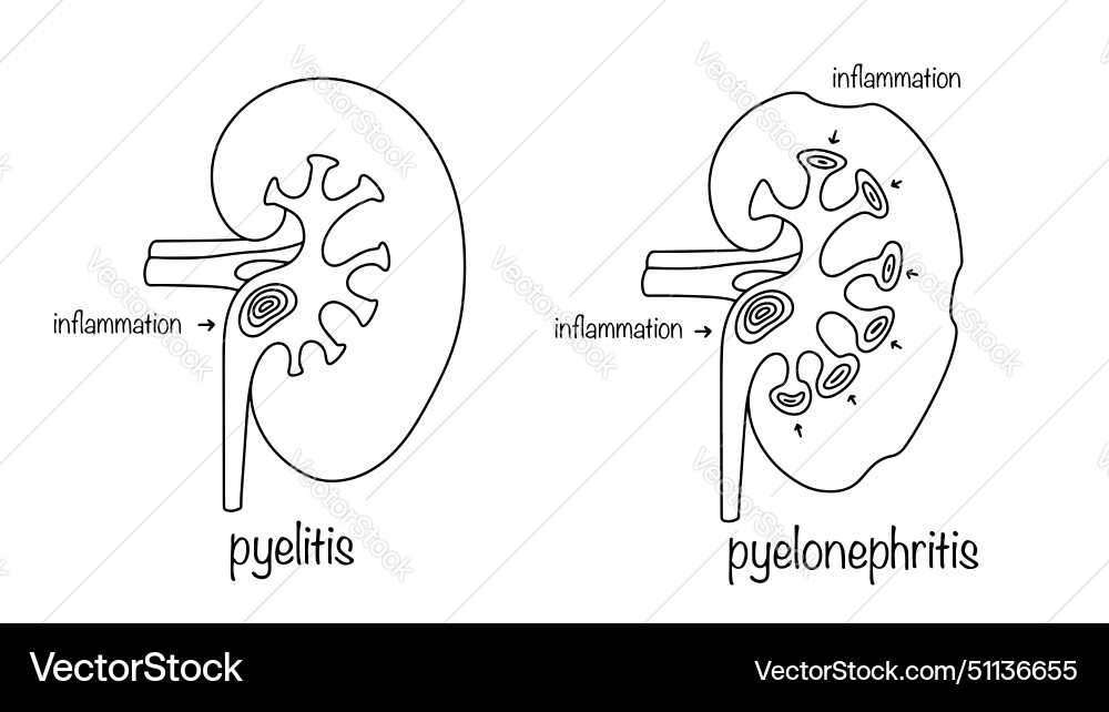 Pyelitis and pyelonephritis Pyelitis and pyelonephritis vector image