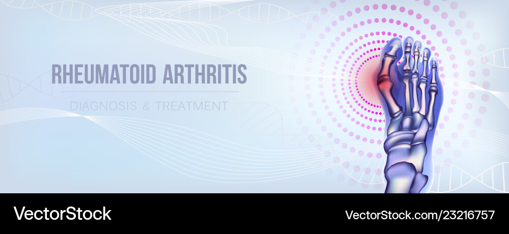 Rheumatoid arthritis bones concept Rheumatoid arthritis bones concept vector image