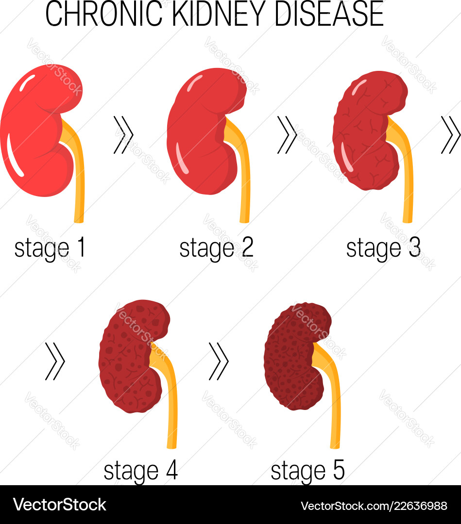 Chronic kidney disease vector image