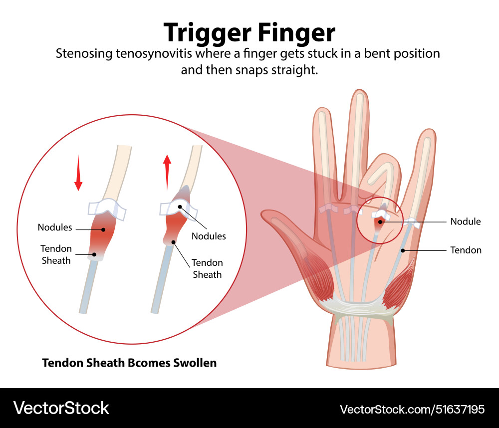 Diagram explaining trigger finger condition Diagram explaining trigger finger condition vector image