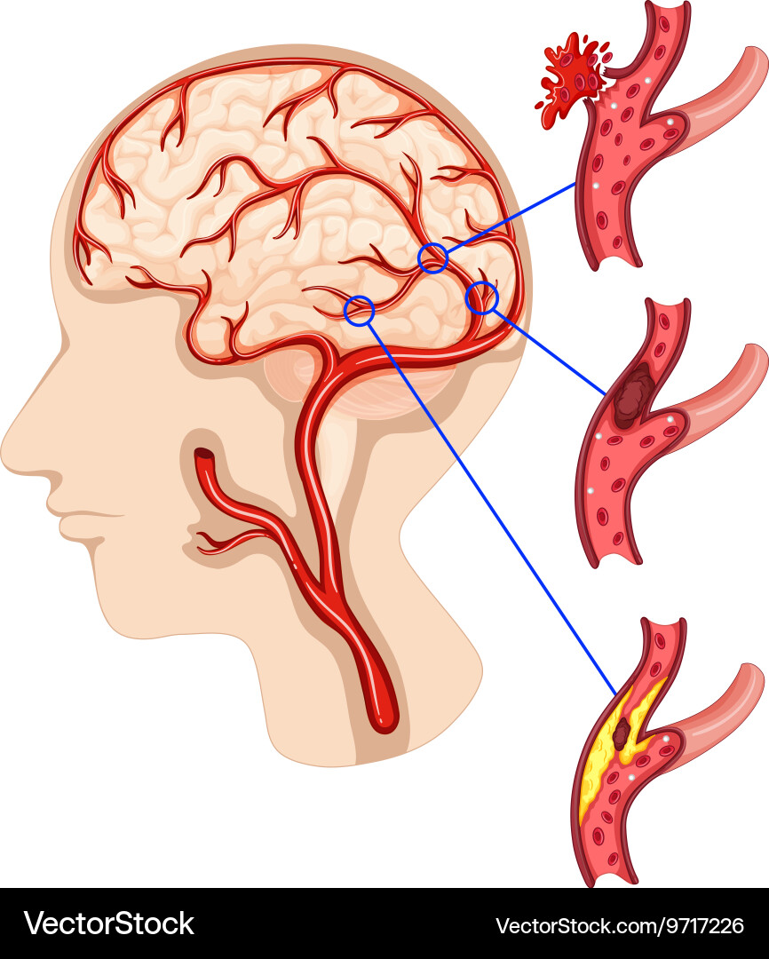 Brain Hemorrhage and Vascular Disease Vector Image