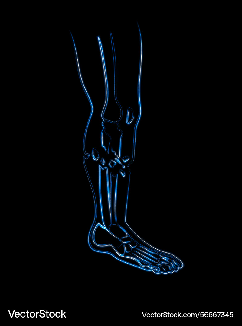 An open fracture of the tibia An open fracture of the tibia vector image