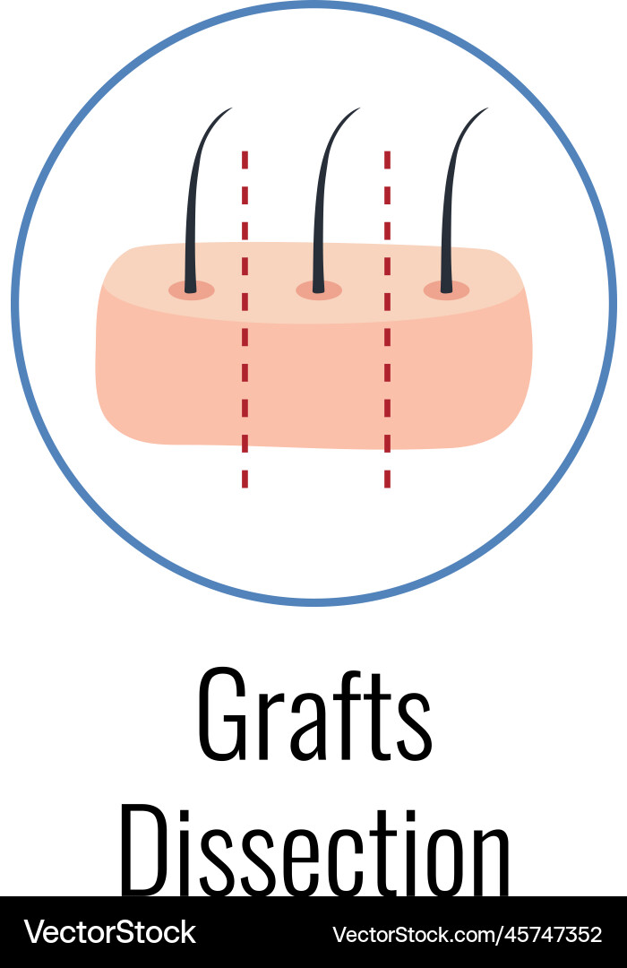 Alopecia grafts dissection composition Royalty Free Vector