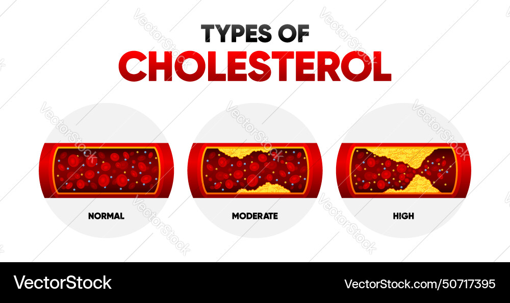 Types cholesterol ldl and hdl level vector image