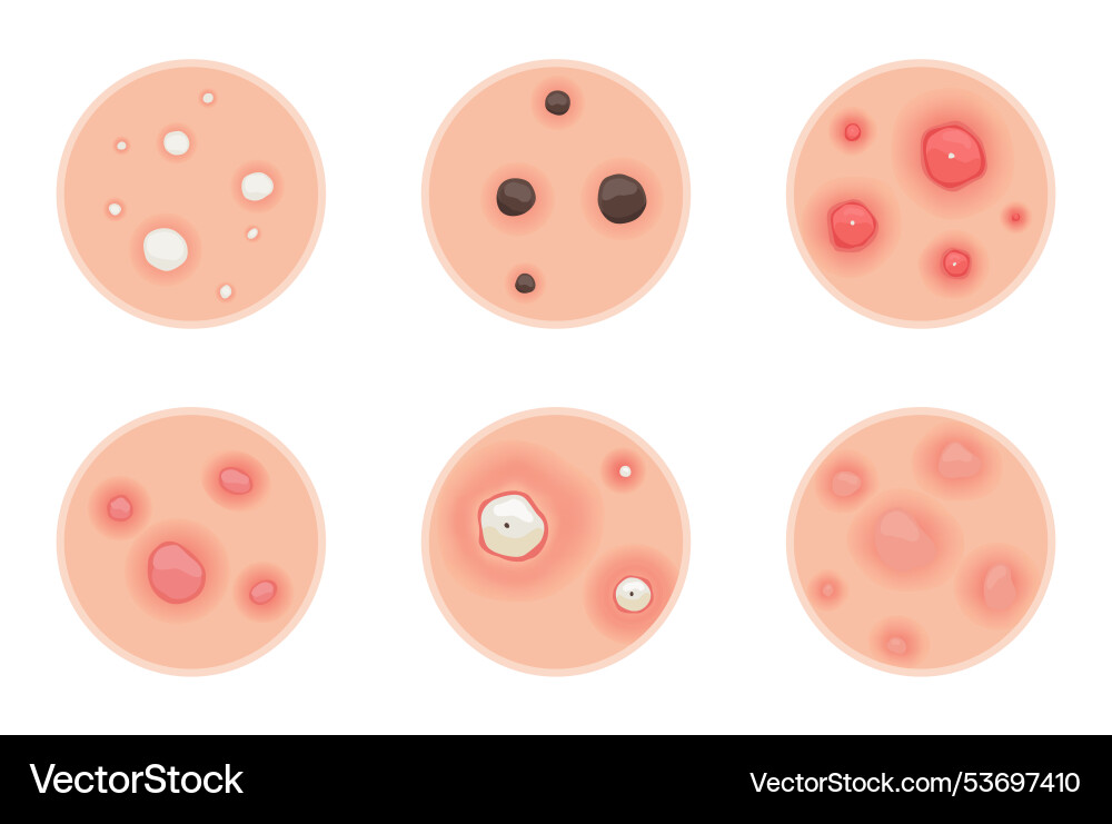 Die Art der Akne verstehen ein umfassendes visuelles Die Art der Akne verstehen ein umfassendes visuelles Vektorbild