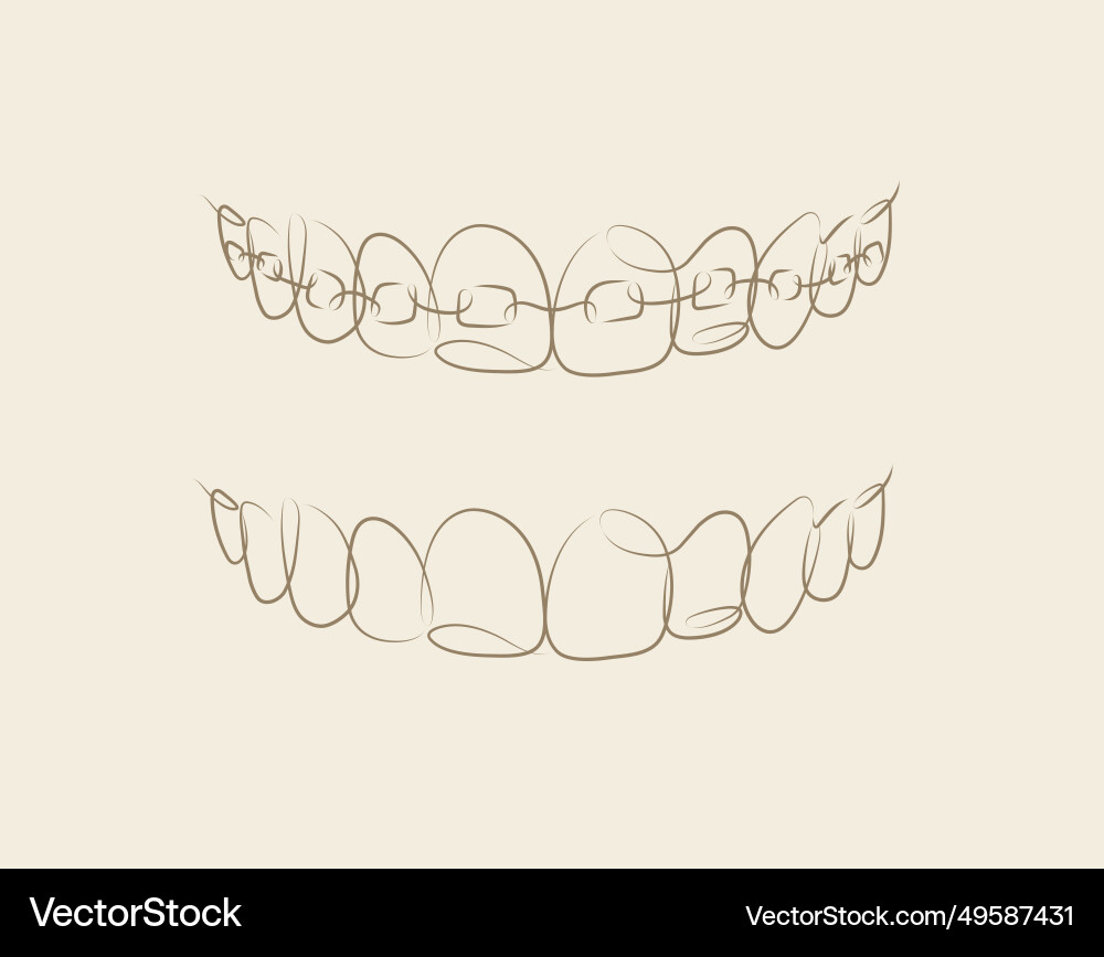 Jaws with and without braces installed drawing Vector Image