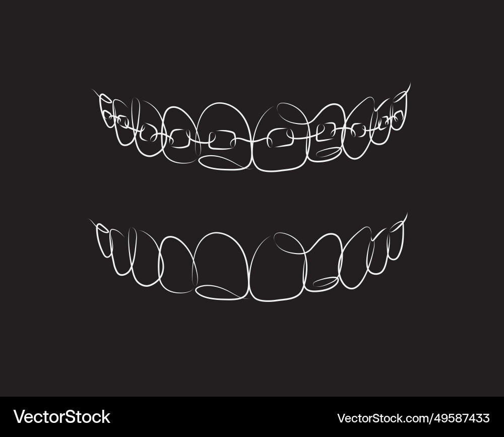 Jaws with and without braces installed drawing Vector Image