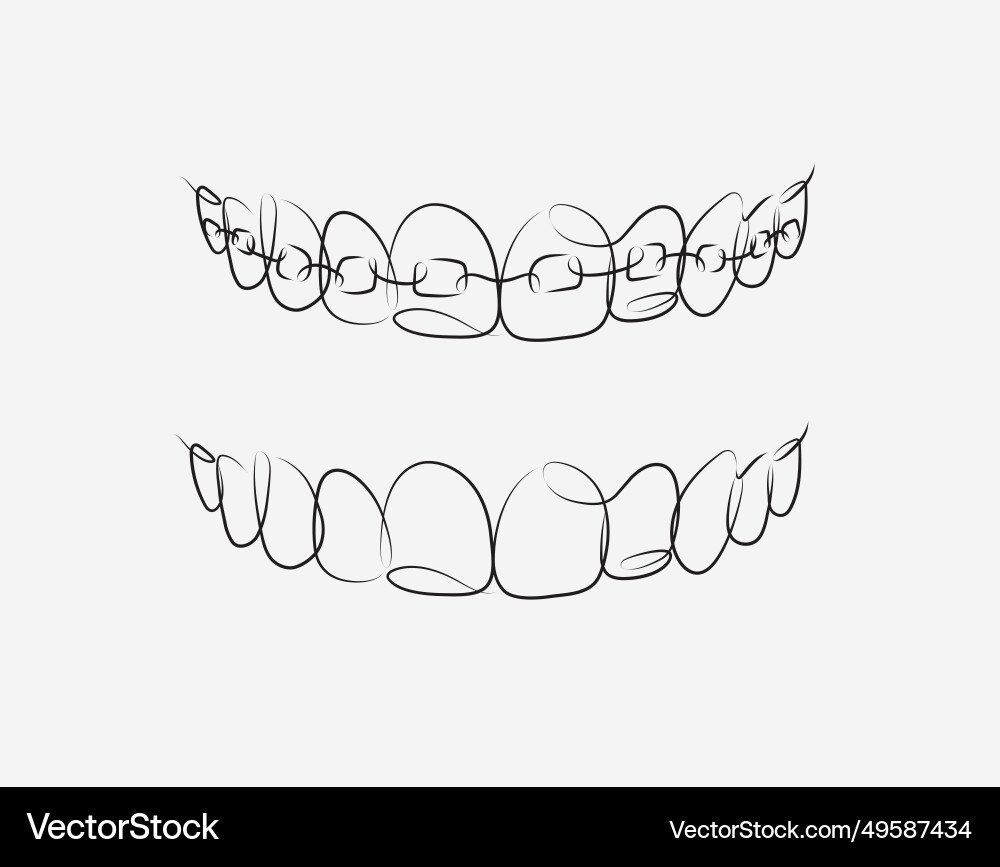 Jaws with and without braces installed drawing Vector Image