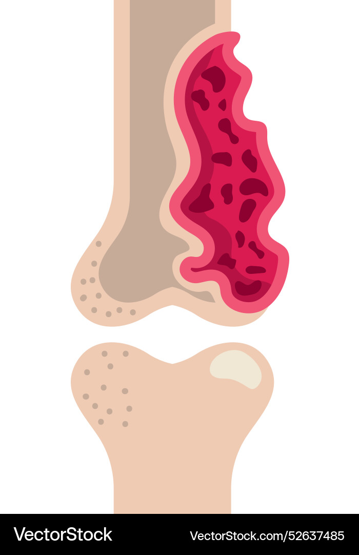 Multiple Myeloma Bone Marrow Cancer Royalty Free Vector